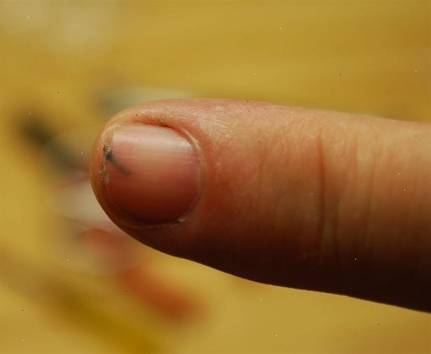 Hur tar man bort en flisa i nageln. Ta en medicinskt lämplig mängd ibuprofen baseras på etiketten informationen.