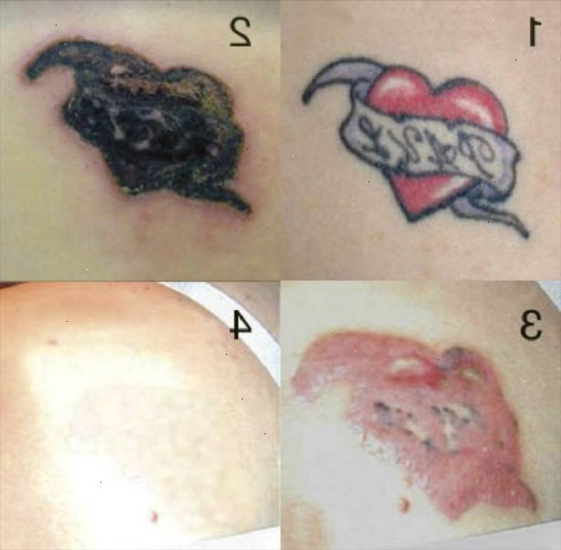 Hur tar man bort en tatuering. Tänk att få din tatuering bort professionellt.