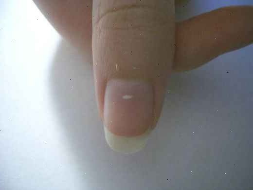 Hur bli av med dessa vita fläckar på naglarna. Lösningen är att helt enkelt låta dem växa ut.