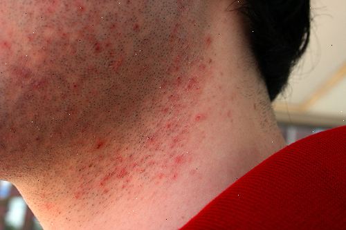 Hur kan man förhindra hudirritation. Tvätta ansiktet med varmt vatten.